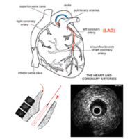 Assessment of Fluid Tissue Interaction Using Multi-Modal Image Fusion for Characterization and Progression of Coronary Atherosclerosis
