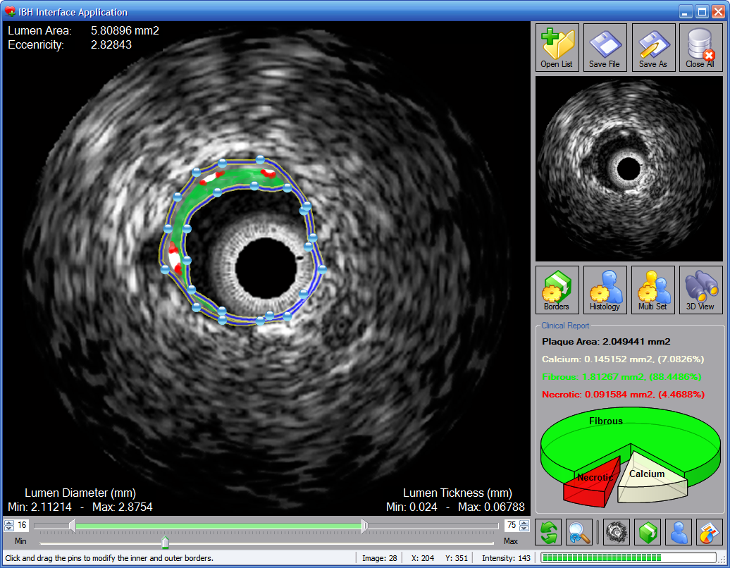 Improvement and Automatic Classification of IVUS-VH (Intravascular Ultrasound  Virtual Histology) Images