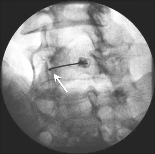 Fluoroscopy-guided lumbar facet joint injection at L45. The oblique spot image shows the intra-articular position of the needle (arrow).